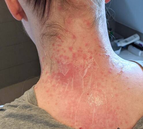 Skin rash EPS Skin rash EPS